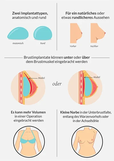Informationen zur Brustvergrößerung mit Brustimplantaten.