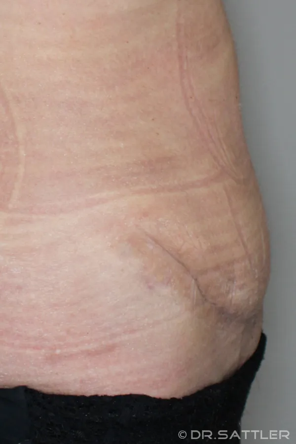Abdominoplasty-Pat-2-side.