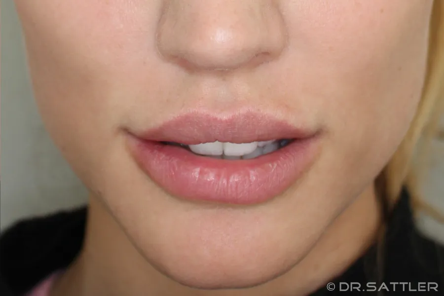 Lippen können mittels Hyaluronsäure vergrößert werden.